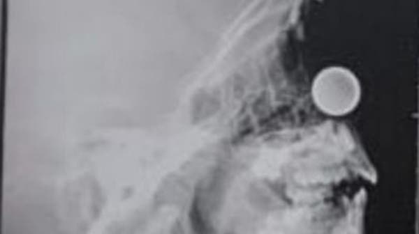 بالصورة.. استخراج عملة معدنية من أنف طفل في مكة