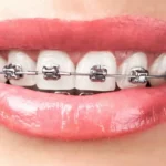 تقويم الاسنان